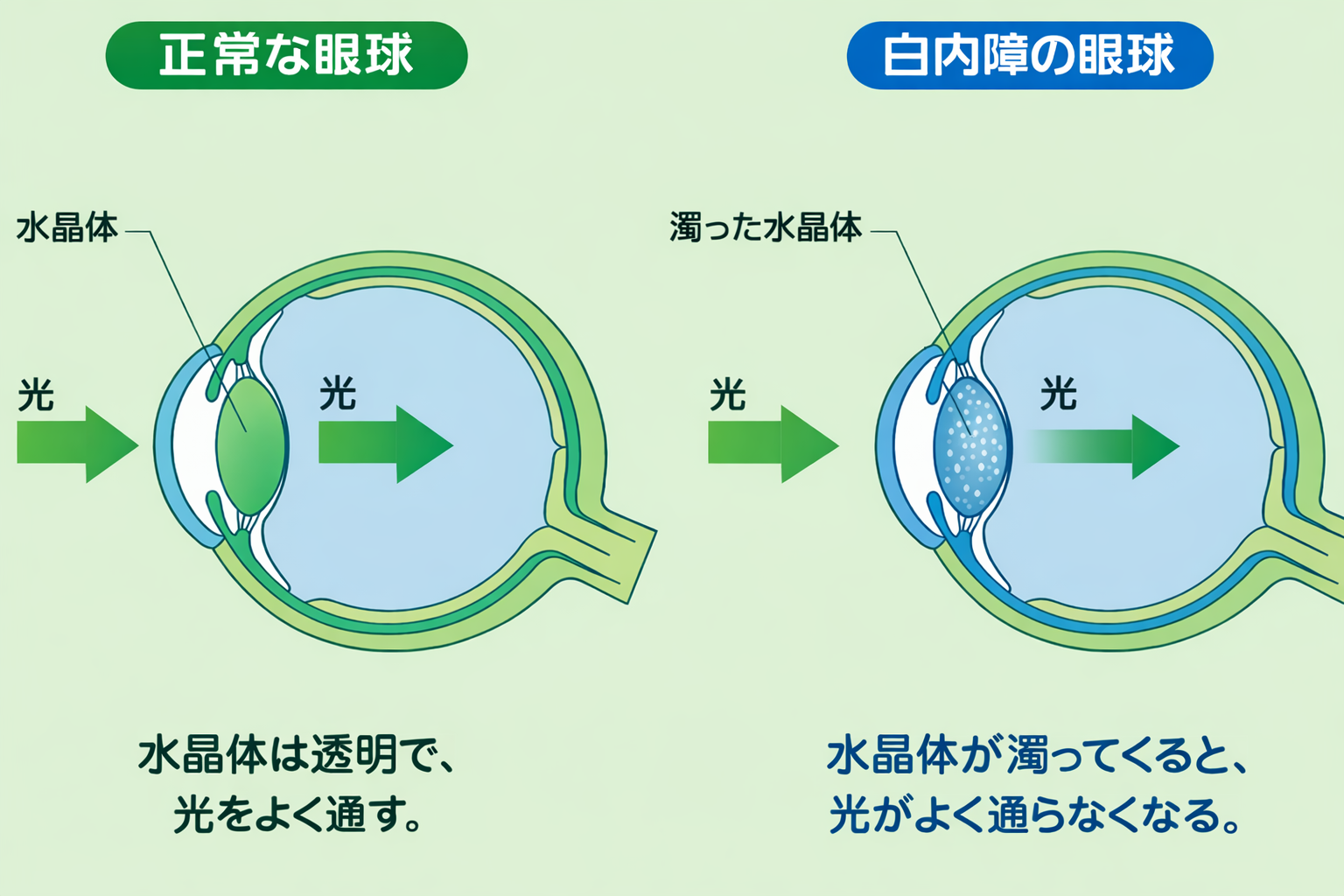 白内障イメージ